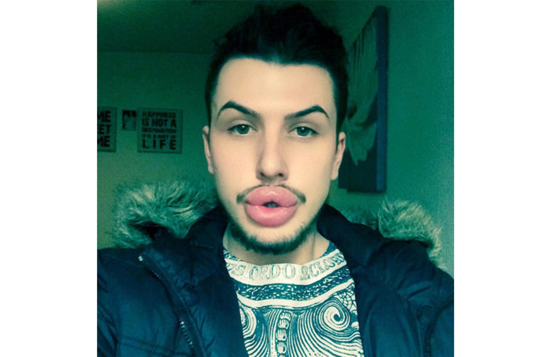 Kylie Jenner – after 