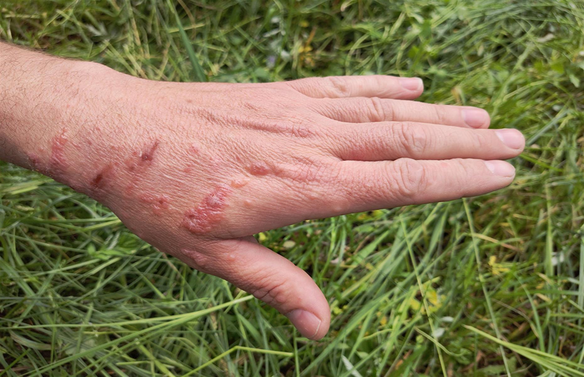 Giant hogweed: what can go wrong